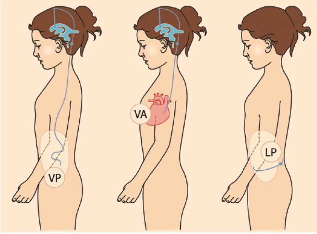 Typy zkratových operací (shuntů).<br>Fig. 3. Types of shunts.