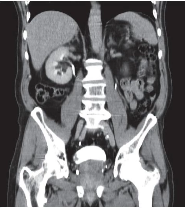 Tumor močového měchýře, CT snímek, vylučovací fáze, koronární scan 
Fig. 3. Bladder tumor, CT image, excretory phase, coronar scan