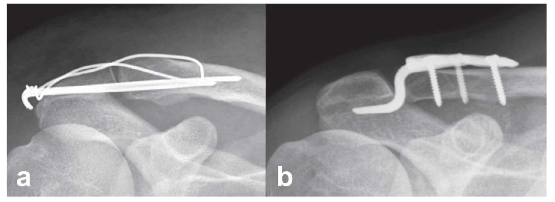 Správné zavedení implantátů: a – tahová cerkláž, b – hákovitá dlaha.
Fig. 1: Correct insertion of implants: a – tension wire cerclage, b – hook plate