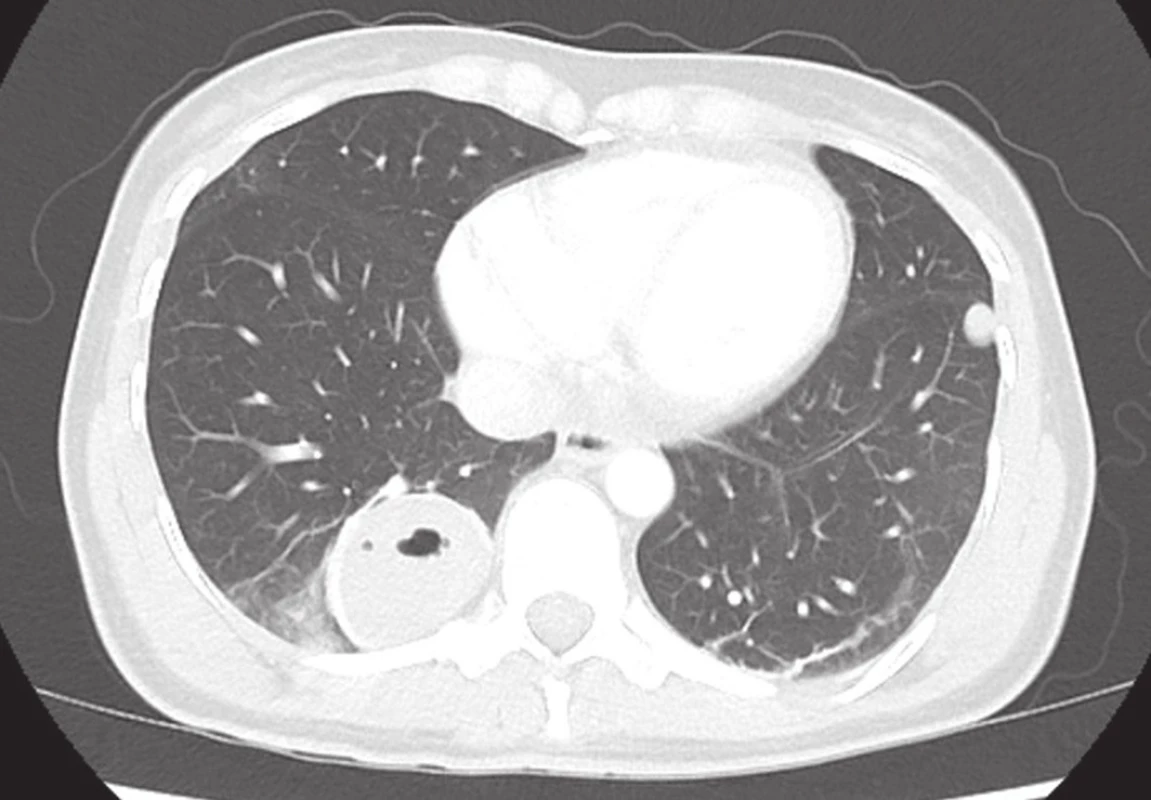 Traumatická plicní pseudocysta v pravém dolním laloku
Fig. 2: Traumatic pulmonary pseudocyst in the right lower lobe