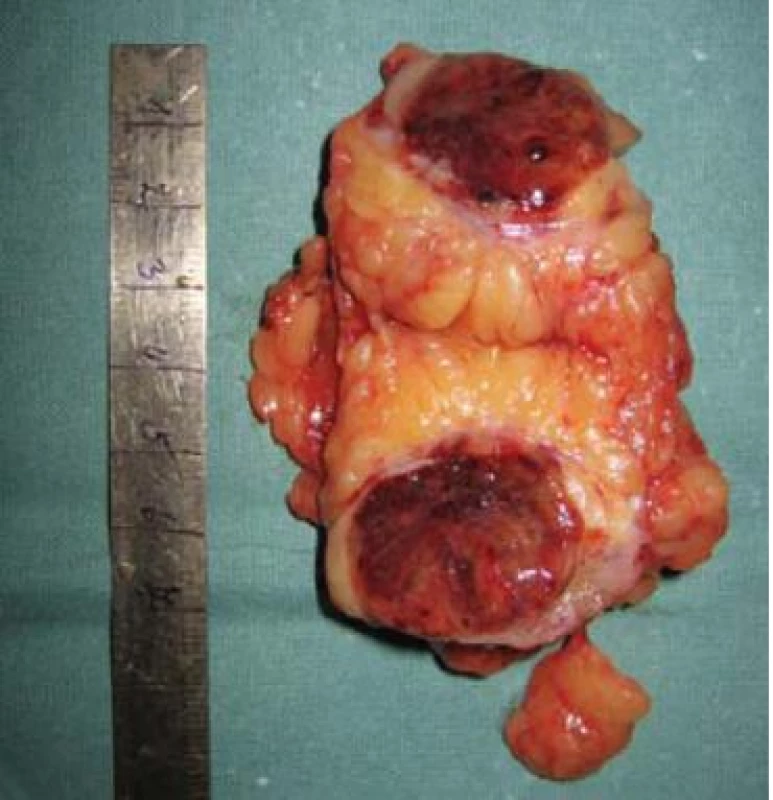 Resekovaný tumor.