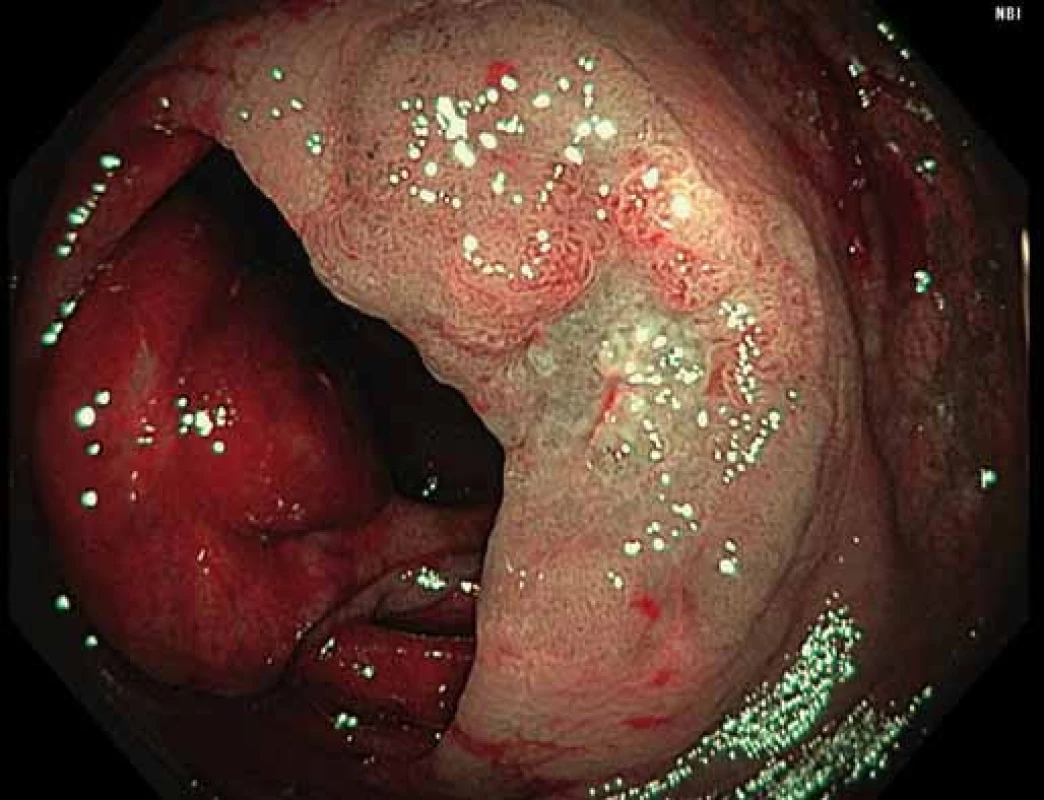 Povrchová neoplastická léze velikosti 30 mm s centrální depresí (0–IIa + IIc dle Pařížské klasifikace) v ascendens (Narrow band imaging).
Fig. 2. Superficial neoplastic lesion of 30 mm with central depression (0–IIa + IIc according to Paris classification) in the ascending colon (Narrow Band Imaging).