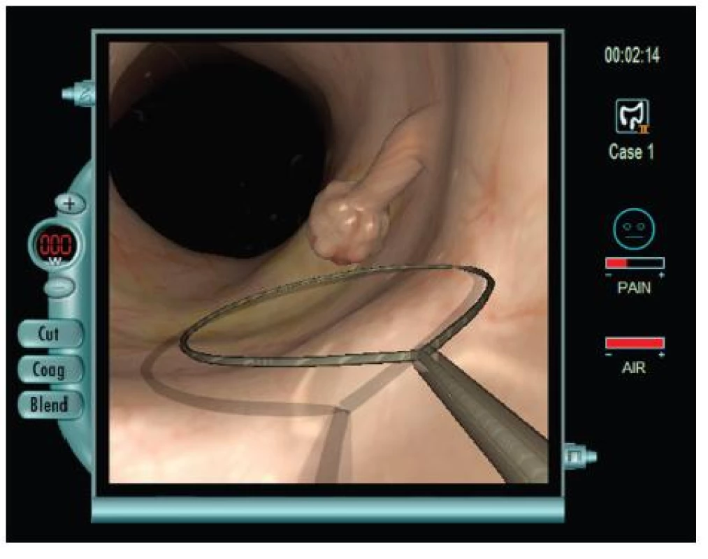 Modul pro koloskopii
V transverzu byl nalezen stopkatý polyp (2 cm v průměru). Polyp bude odstraněn endoskopickou polypektomií pomocí diatermické kličky (za použití smíšeného proudu).