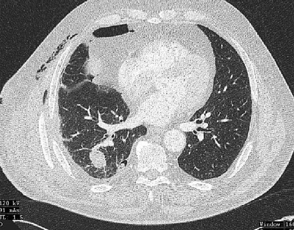 CT plic po provedení RFA ložiska v dolním laloku pravé plíce neprokazuje známky viabilní neoplazie
Fig. 2: CT after RFAof the foci in the lower lobe of the right lung does not show signs of viable neoplasm