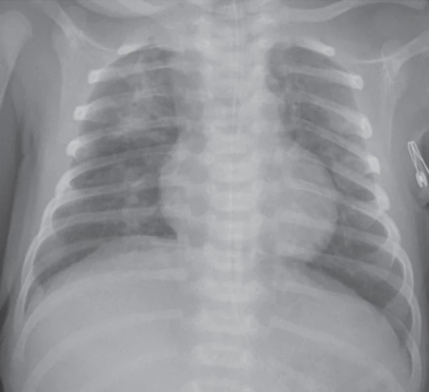 Syndrom aspirace mekonia (MAS) s heterogenním obou stranným postižením – disperzní zastínění až difuzně splývající  infiltráty predominantně v pravé plíci