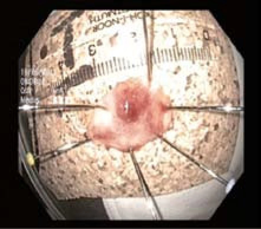 Vzorek po endoskopické resekci vypnutý na korek.
Fig. 5. ER specimen.
