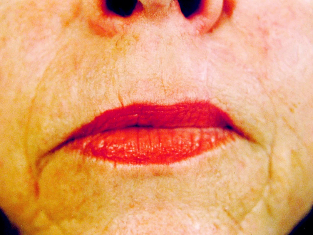 Stav po excizi basaliomu horního rtu se spontální epitelizací
Pic. 4. Excision of the upper lip basalioma with spontaneous epitalization – the postoperative condition