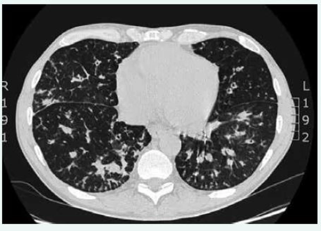 CT plic a mediastina a HRCT plic u pacienta s CVID. Difuzně jsou přítomny bronchiektázie a intersticiální plicní proces (histologicky verifikován jako nespecifická intersticiální pneumonie). CT hrudníku poskytla MUDr. Martina Doubková
