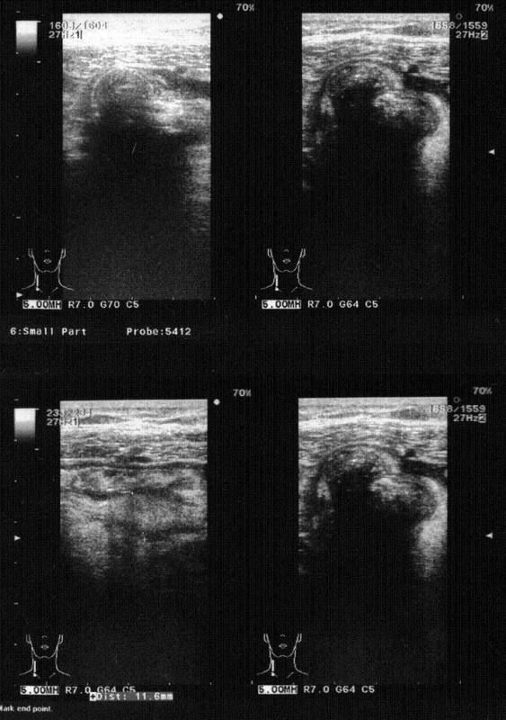 USG obraz ileocekálneho prechodu pred operáciou
Fig. 1. Preoperative USG view of ileo-cecal region
