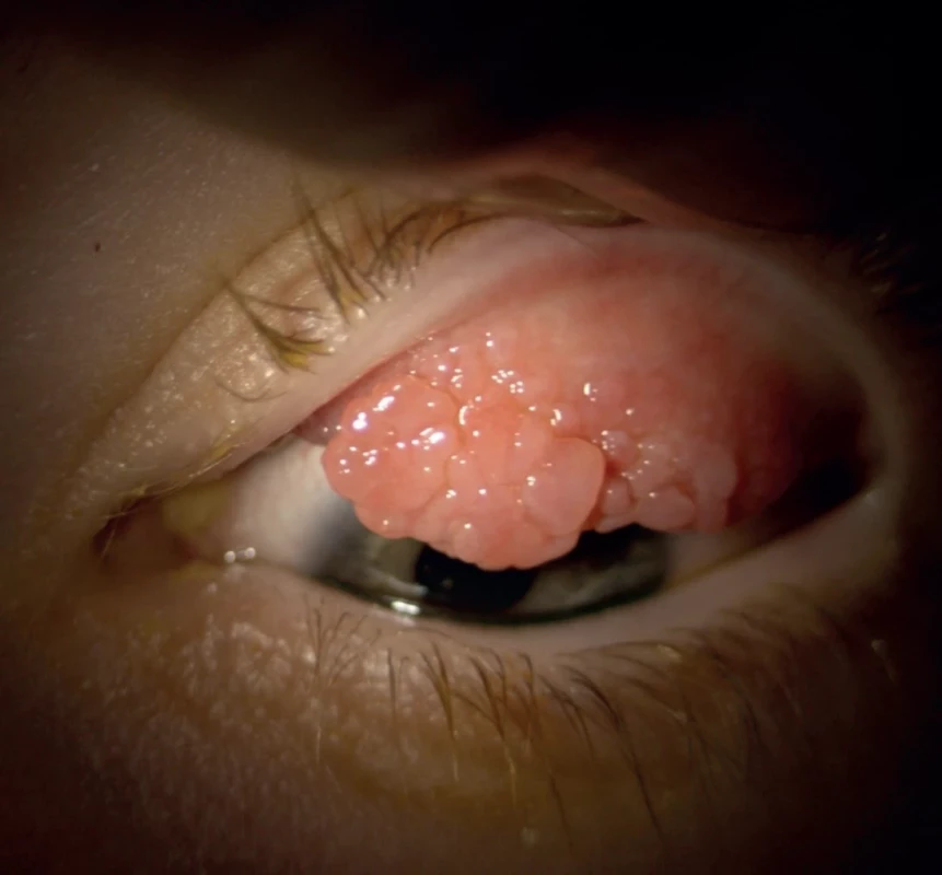 Patient with vernal keratoconjunctivitis