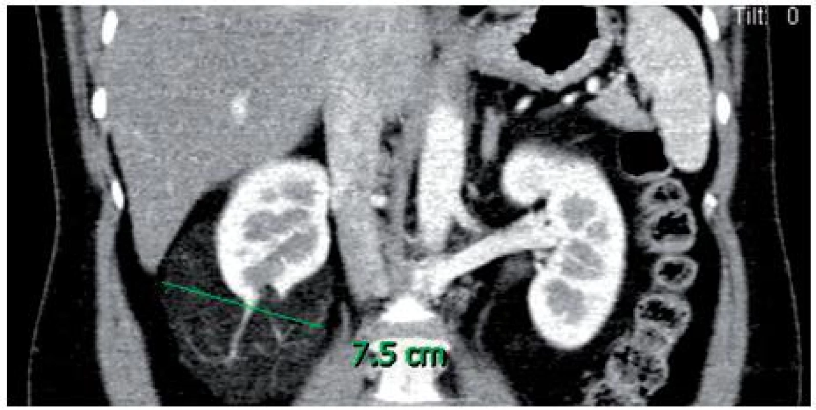 CT snímek tumoru
Fig. 1. CT of tumour
