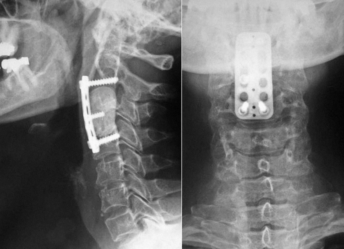 Náhrada obratlového těla C3 po odstranění metastázy předoperačně neznámého histologického původu, která byla efinitivně pospána jako sekundární ložisko karcinoidu. Blok kostního cementu vyplňující defekt po resekci jistí dlaha s bikortikálními šrouby.