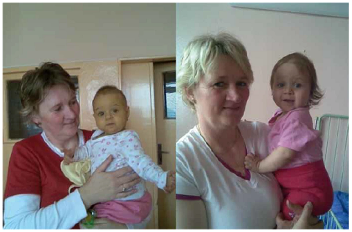 Dieťa pred a po transplantácii pečene od žijúceho darcu (matky) pre artéziu žlčových ciest.
Fig. 1. A child before and after liver transplantation from a living donor (mother) due to biliary atresia.
