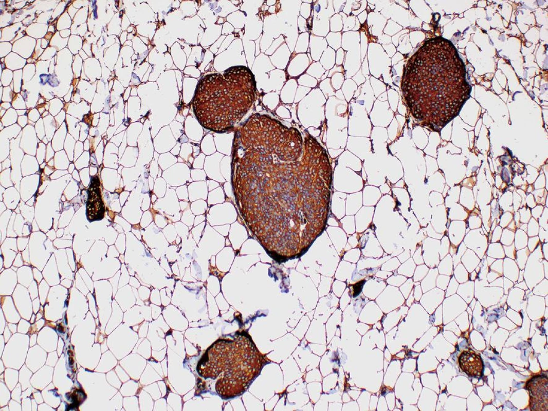Imunohistochemický průkaz vimentinu v meningoteliálních buňkách