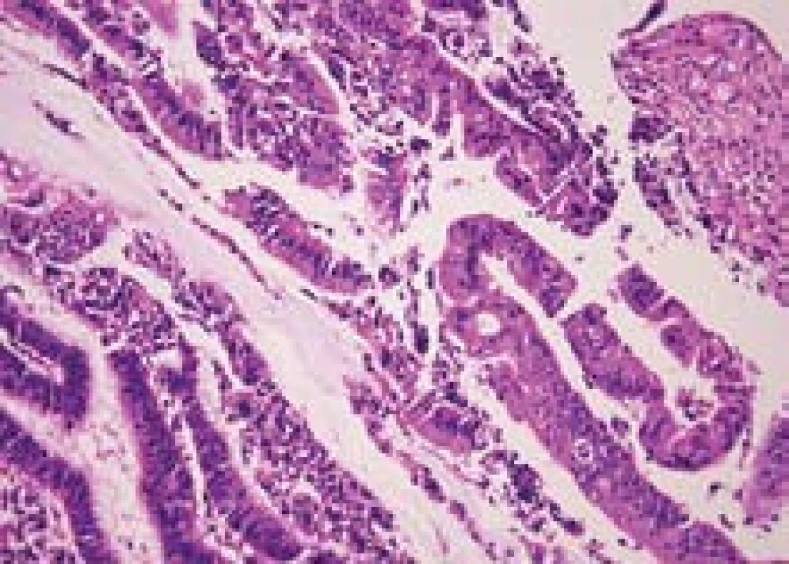 Duktální karcinom v terénu autoimunní pankreatitidy.
Fig. 6. Ductal carcinoma during the course of autoimmune pancreatitis.