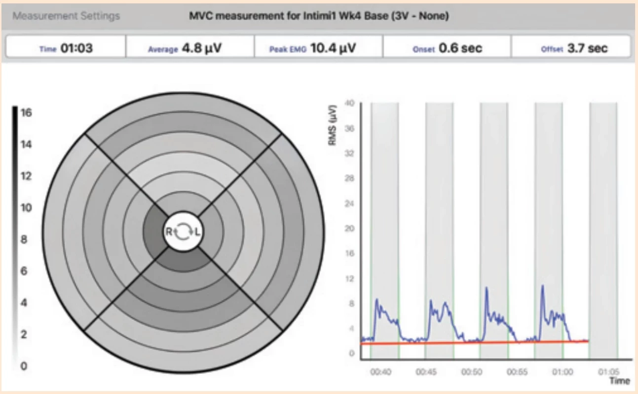Příklad měření EMG aktivity svalů pánevního dna pomocí zařízení MAPLe při maximální volní kontrakci. Fig. 1. Example of measuring EMG activity of pelvic fl oor muscles using the MAPLe device during maximum voluntary contraction.