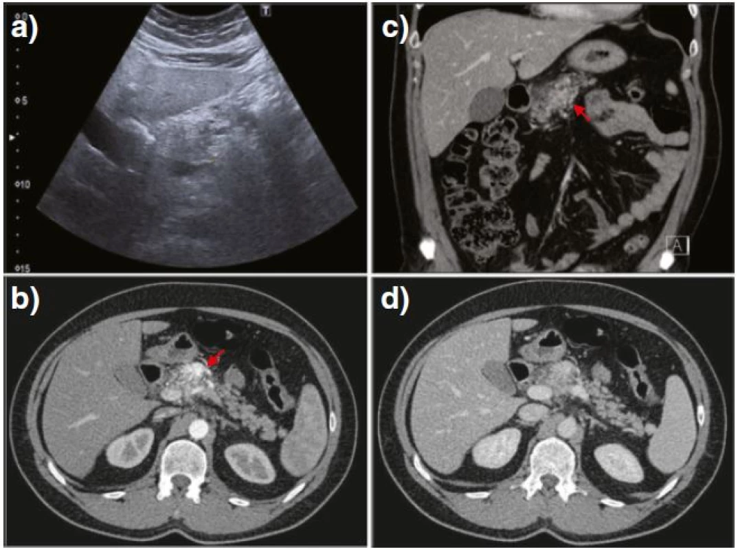 US imaging showed a structurally heterogeneous and thickened neck of the pancreas, hardly differentiated from the surrounding fat and without any dilatation of the main pancreatic duct (a). Contrast-enhanced CT examination through the pancreas demonstrated a mosaic hypervascular area at the same site as the initial US (b–d, <i>red arrows</i>)