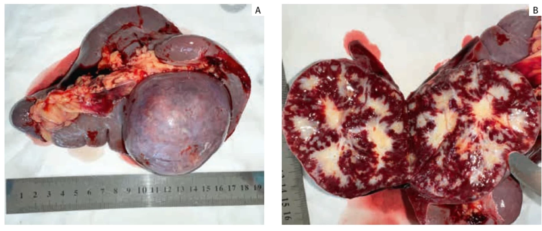 The resected spleen specimen displaying an approximately 8.5 cm mass located in the upper pole of the spleen. Resekovaný vzorek sleziny vykazující přibližně 8,5 cm velkou masu umístěnou v horním pólu sleziny.