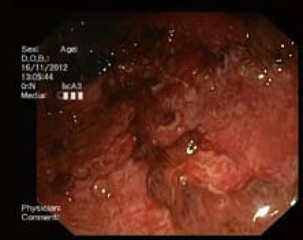 Těžká ulcerózní kolitida s rozsáhlými vředy.
Fig. 4. Serious ulcerative colitis with extensive ulcers.
