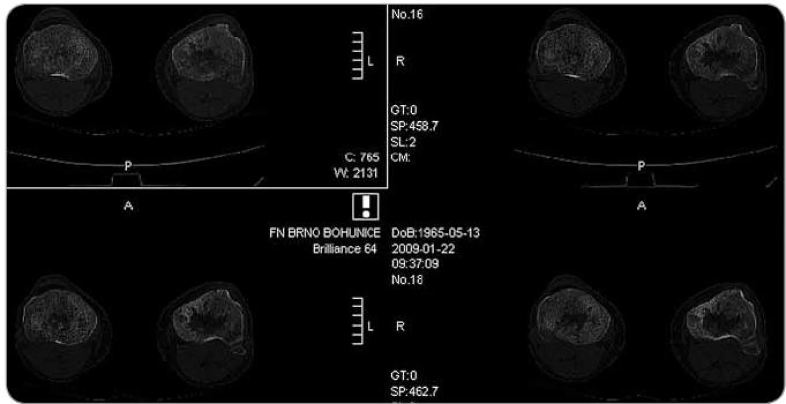 Zobrazení tibie metodou multidetektorového CT , axiální řez. Zřetelná osteoporotická struktura s osteosklerotickými ložisky.