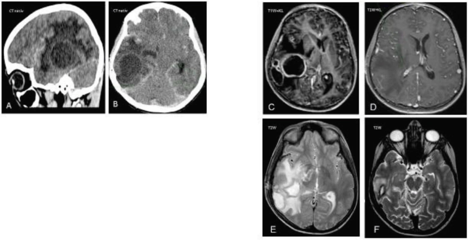 CT a MRI mozgu s početnými abscesmi u pacienta č. 2.
A–B. V natívnom CT obraze sa zobrazuje 5 abscesových ložísk v pravej hemisfére s hlavným ložiskom temporo-fronto-okcipitálne vpravo veľkosti 38 x 36 x 42 mm, s perifokálnym edémom a presunom stredových štruktúr, s leptomeningitídou a známkami intrakraniálnej hypertenzie.
C–F. MRI v T1W s kontrastom zobrazuje 4 abscesové ložiská.
E. Supratentoriálne temporálne vpravo reziduálna abscesová dutina, parciálne kolabovaná.
Fig. 2. CT and MRI of multiple absceses in a case 2.
A–B. CT scans demonstrate 5 abscesses in a right hemisphere. The largest abscess is located in the right temporo-fronto-occipital area in diameter 38 x 36 x 42 mm, a perifocal edema, a leptomeningitis and the signs of a intracranial hypertension are present. The right frontal lobe of brain is shifted across the midline.
C–F. T1-weighted MRI images with a gadolinium contrast demonstrate 4 abscesses.
E. A residual abscess cavity located within the right temporal area is partially collapsed