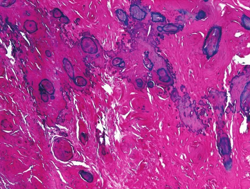 Histologicky je léze charakteristická denzní kolagenní tkání, někdy s ložisky rozsáhlých kalcifikací. HE, 200x
