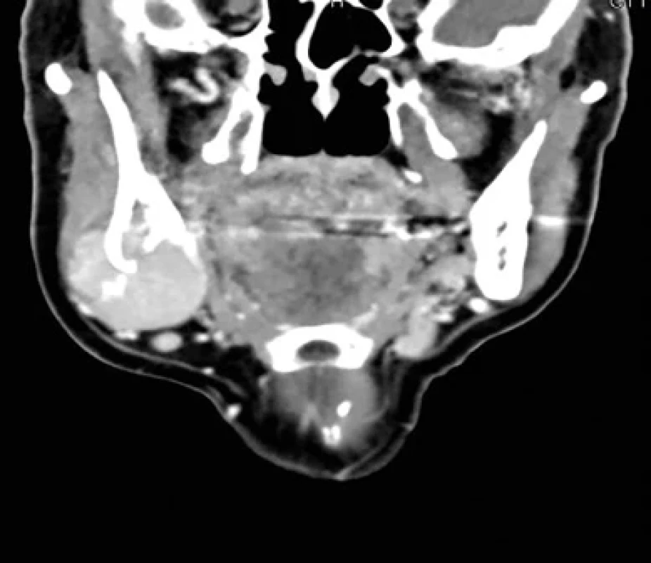CT s kontrastem: V.s. tumor mandibuly vpravo maligního vzhledu.