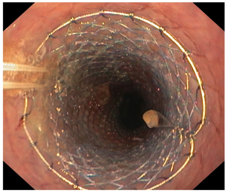Endoskopický obraz zavedeného zavěšeného jícnového
stentu<br>
Fig. 4: Endoscopic image of an inserted suspended esophageal
stent