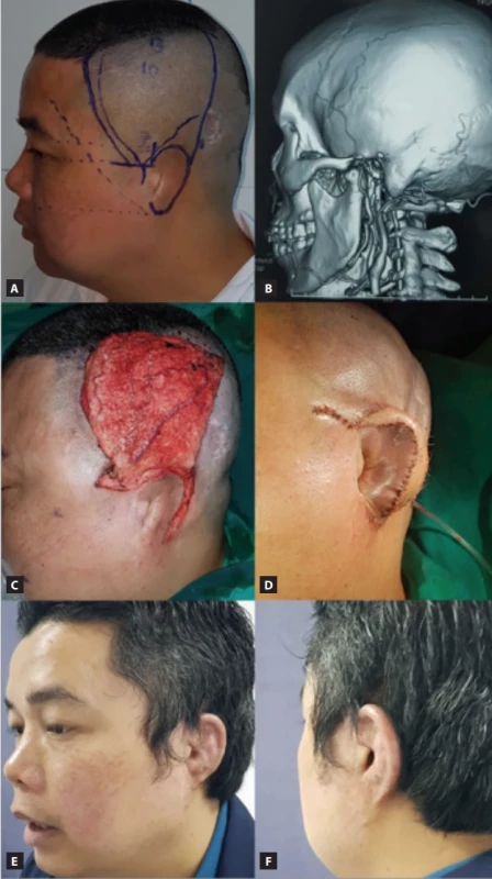 Single-stage traumatic ear reconstruction with artifi cial framework. (A) 39-year-old male patient, post-traumatic ear amputation; (B) CT angiography shows superfi cial temporal arteries still preserved during the emergency stage; (C) harvest the temporoparietal fascia fl ap with an endoscopic technique with full branch frontal and parietal; (D) immediate reconstructed ear post-operative result, no scar on the scalp; (E,F) 6 months post-operative result.