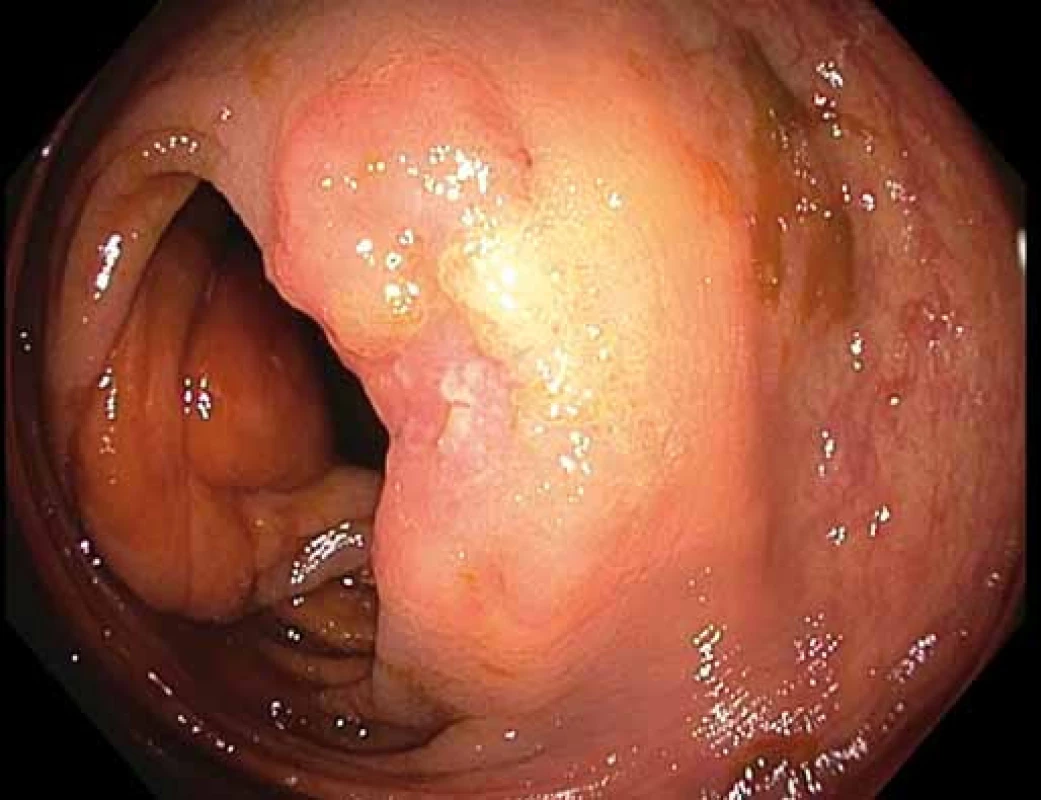 Povrchová neoplastická léze velikosti 30 mm s centrální depresí (0–IIa + IIc dle Pařížské klasifikace) v ascendens (v bílém světle).
Fig. 1. Superficial neoplastic lesion of  30 mm with central depression (0–IIa + IIc according to the Paris classification) in the ascending colon (white light).