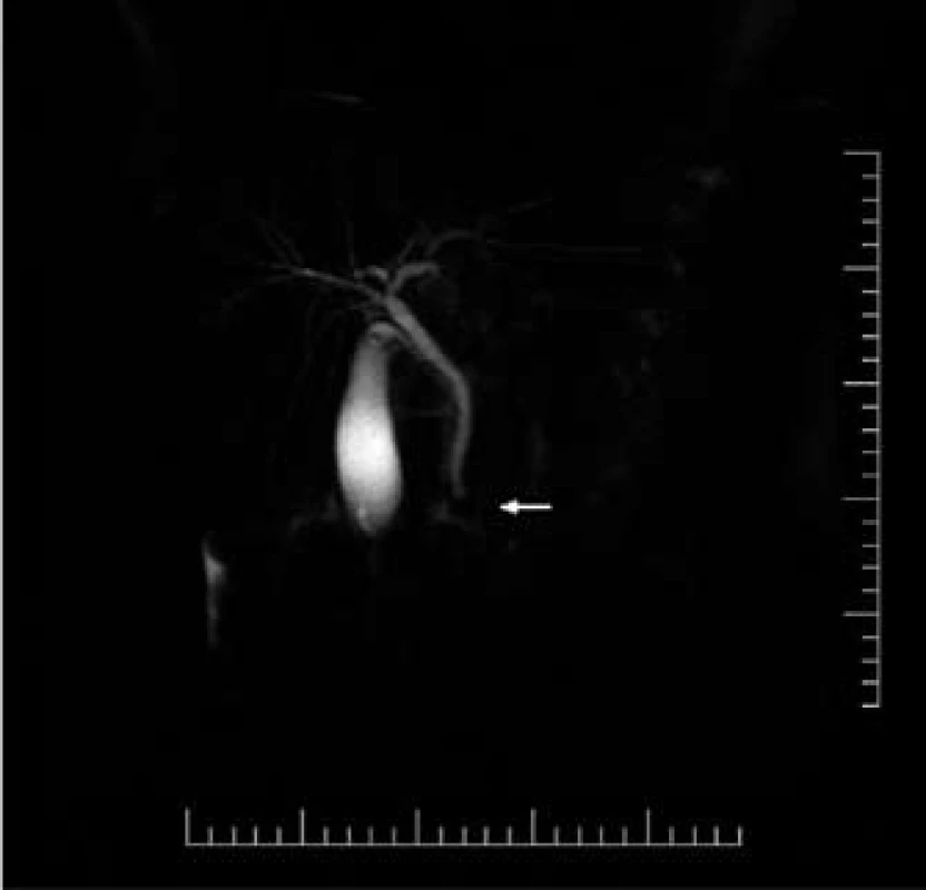 Falešně pozitivní nález na MRC P nad Vaterovou papilou (šipka). Při následném ERC P nebyl konkrement nalezen.
Fig. 1. False positive finding on MRCP in the area of Vater’s papilla (arrow). No lithiasis was found during the subsequent ERCP.