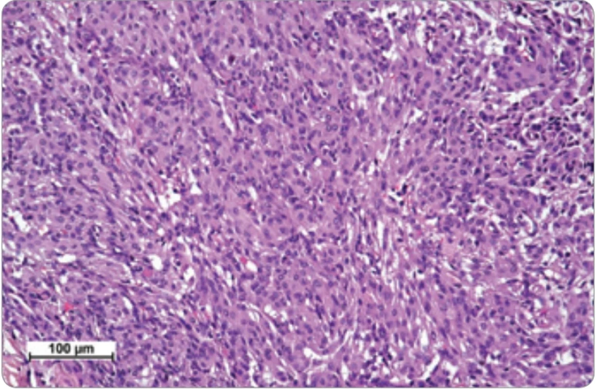 Histologie. Struktury meningoteliálního meningeomu, WHO G1, rostoucího v  podobě proplétajících se fasciklů meningoteliálních buněk. Nádorové elementy s oválnými jádry, bez signifi kantních cytonukleárních atypií či zachycené mitotické aktivity. V rámci neoplazie nezachycena nekrotizace ani invaze do mozkové tkáně. Původní zvětšení 200×, hematoxylin eozin.