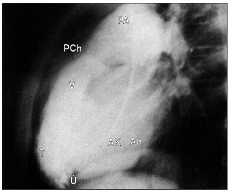 Boční projekce: faktické ústí trikuspidální chlopně vidíme mezi vtokovou a výtokovou částí PK. Ztluštělá pulmonální chlopeň.