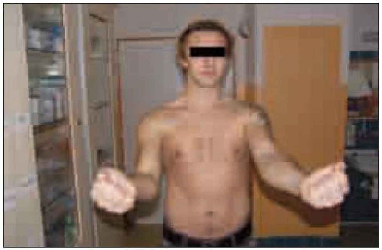 Foto pacienta: dva roky po neurochirurgické operaci s patrnou dobrou funkcí n. musculocutaneus, dobrou trofikou bicepsu a viditelnou jizvou po revizi.