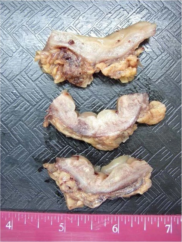 Macroscopy of the resected colon: Multiple cross sections of the bowel show normal appearing mucosa and a markedly thickened edematous wall measuring up to 15 mm