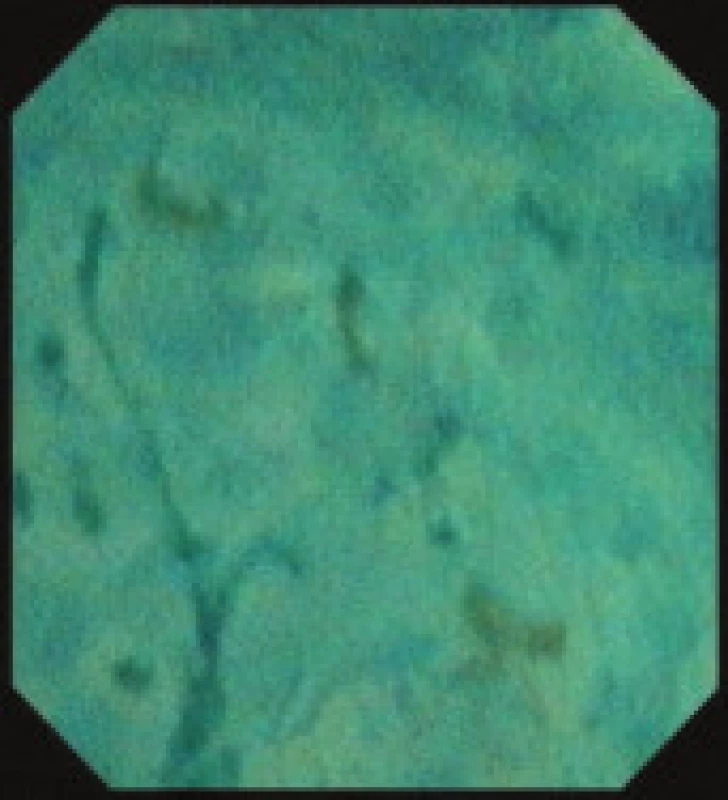 Endocytoskopický nález karcinomu jícnu.