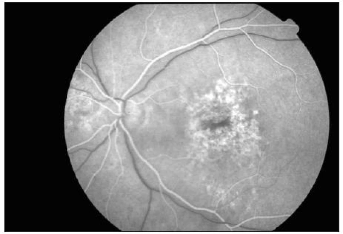 Arteriovenózní fáze fluorescenční angiografie