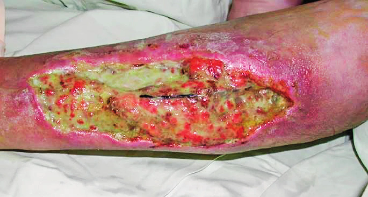 72-year-old warfarinised female patient (atrial fibrillation) with defect of the left lower leg caused by infected haematoma created after an injury. Patient was transferred from another hospital 21 days post injury after incision and evacuation of the hematoma.
