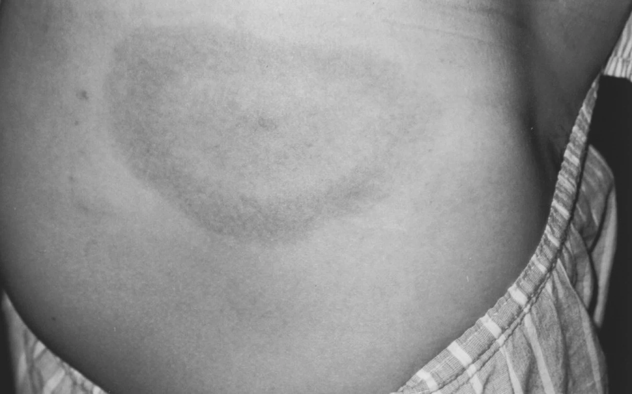 43letý muž s typickým E. m. o průměru 12 cm na pravé hýždi. Klíště nepozoroval. Přeléčen 3 baleními Deoxymykoinu. Protilátky proti borreliím byly negativní. Výskyt v 9. měsíci.