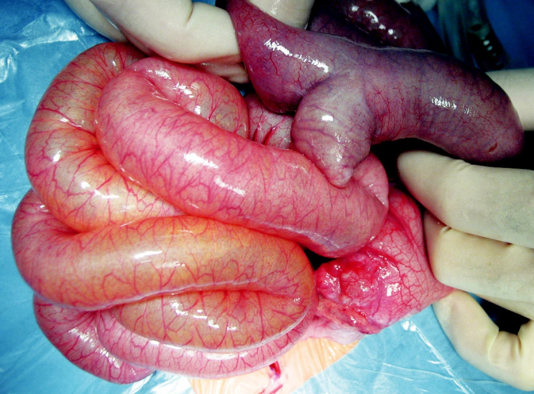 Meckelov divertikul, dilatované kľučky tenkého čreva
Fig. 4. Meckel’s diverticle, dilated small intestinal loops