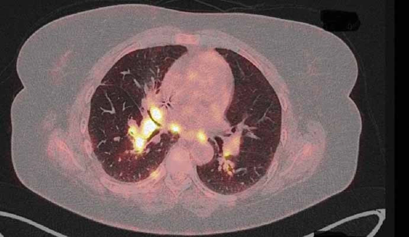 PET/CT z 22. 6. 2015 před zahájením léčby crizotinibem.