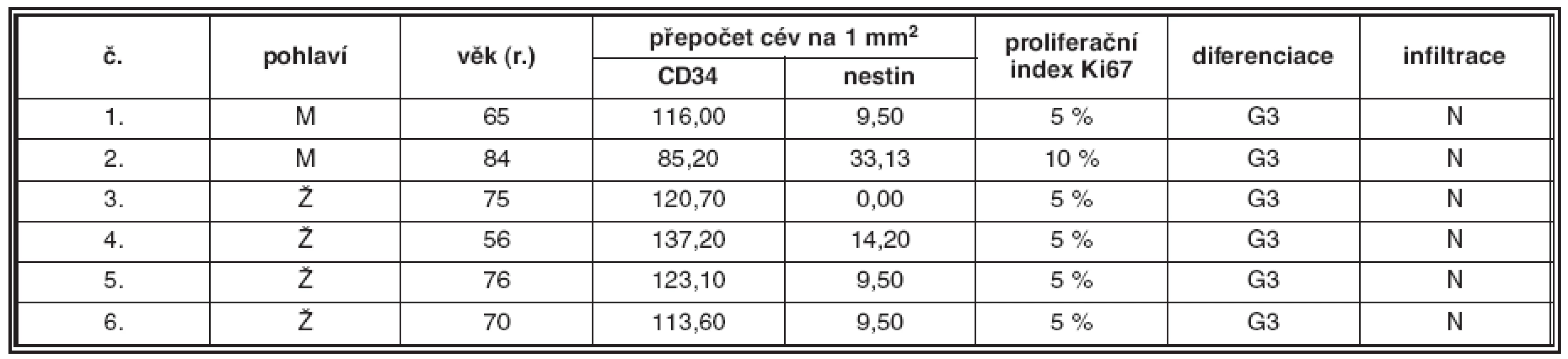Plazmocytární myelom G3, nodulární infiltrace
