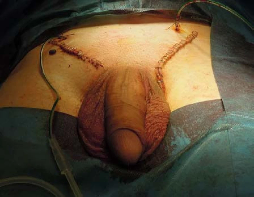 Stav po bilaterální radikální orchiektomii s Redon drény in situ
Fig. 5. Photo right after bilateral radical orchiectomy with Redon drains