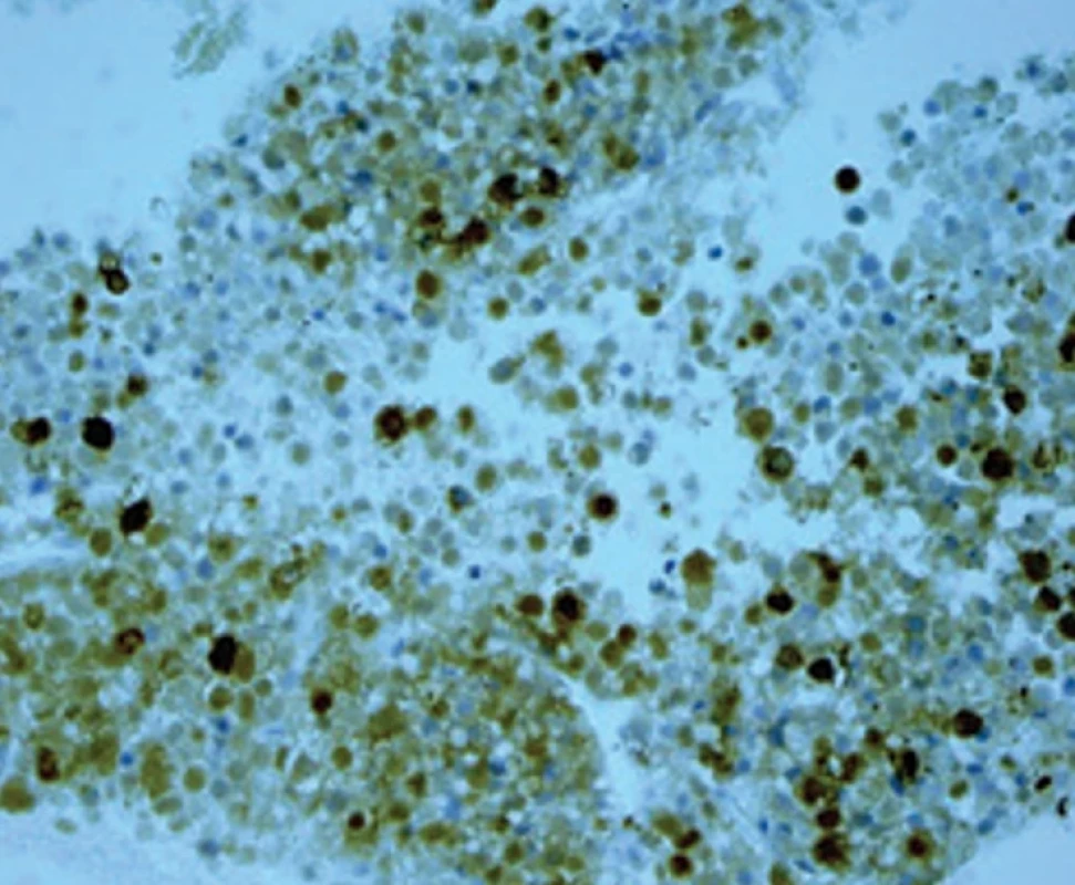 Pozitivní průkaz S-100 proteinů – ložisková pozitivita buněk maligního melanomu. Fig. 6.  Positive detection of  S-100 proteins – locus positivity of malignant melanoma cells.