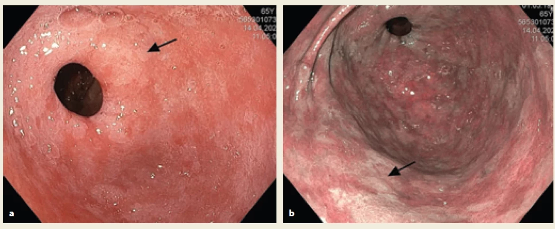 Gastroskopický obraz intestinální metaplazie (označeno šipkou) u 68leté pacientky vyšetřovaná pro chronickou atrofi ckou gastritidu a intestinální metaplazii s low-grade dysplazií. 1a) zobrazení v bílém světle; 1b) zobrazení pomocí metody chromoendoskopie (Narrow Band Imaging).