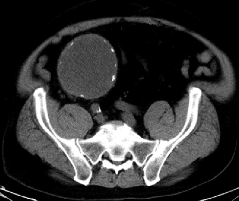 CT vyšetření – transverzální řez
Fig. 1: CT examination – transversal scan