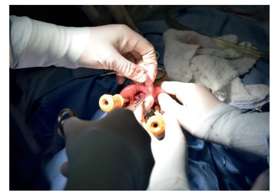Extrakce preparátu v endobagu<br>
Fig. 4: Extraction of the preparation in the endobag