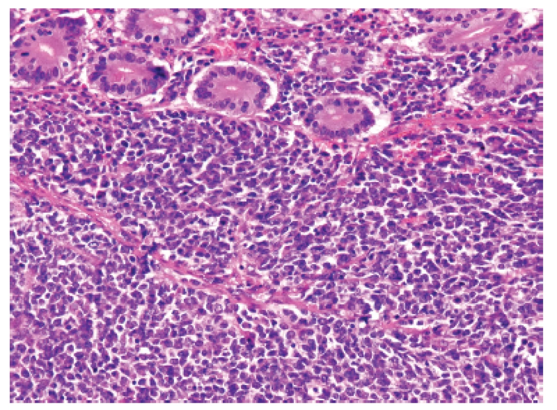 Kazuistika <b>1</b>. Solidní primitivní nediferencovaný tumor z oválných „modrých“ buněk prostupující stěnu tenkého střeva těsně pod sliznici (HE, 200x).