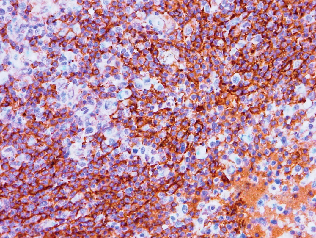 Vzorek z 1. bioptického odběru z roku 2013 – AITL 
CD23 pozitivita hyperplastických sítí folikulárních dendritických buněk.