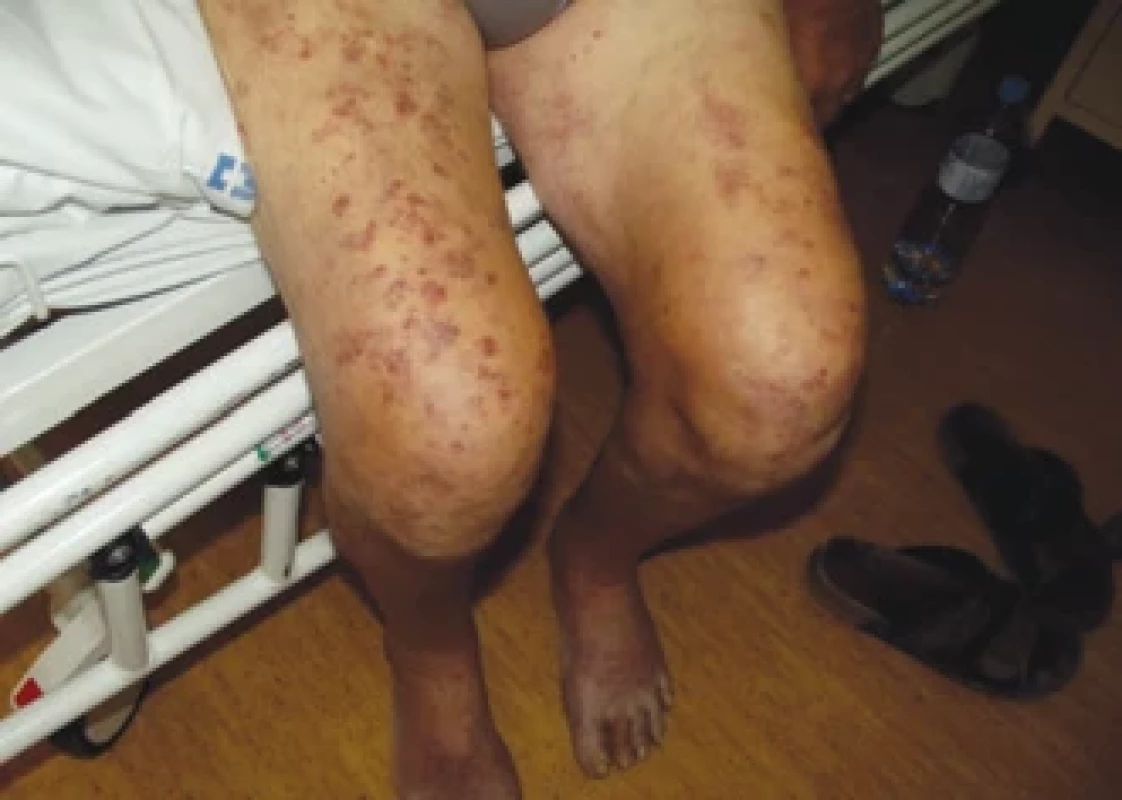 Kožní změny při VEXAS syndromu, dermatologická diagnóza byla neutrofi lní dermatitida, Sweetův syndrom.